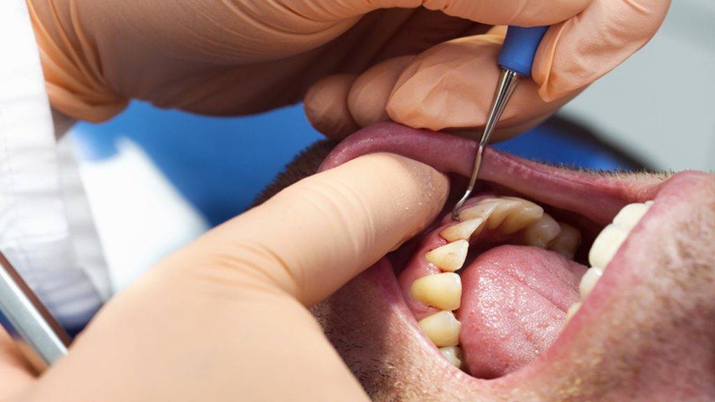 Les méfaits du tabac sur les dents et les gencives