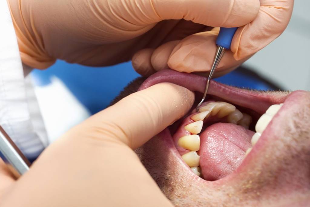 Les méfaits du tabac sur les dents et les gencives