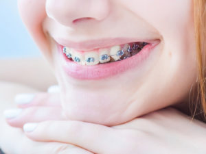 Ces très chers soins d’orthodontie