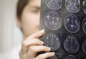 Dérivés de la progestérone et risque de méningiome : le GHU de Paris propose un accès rapide au dépistage pour les patientes